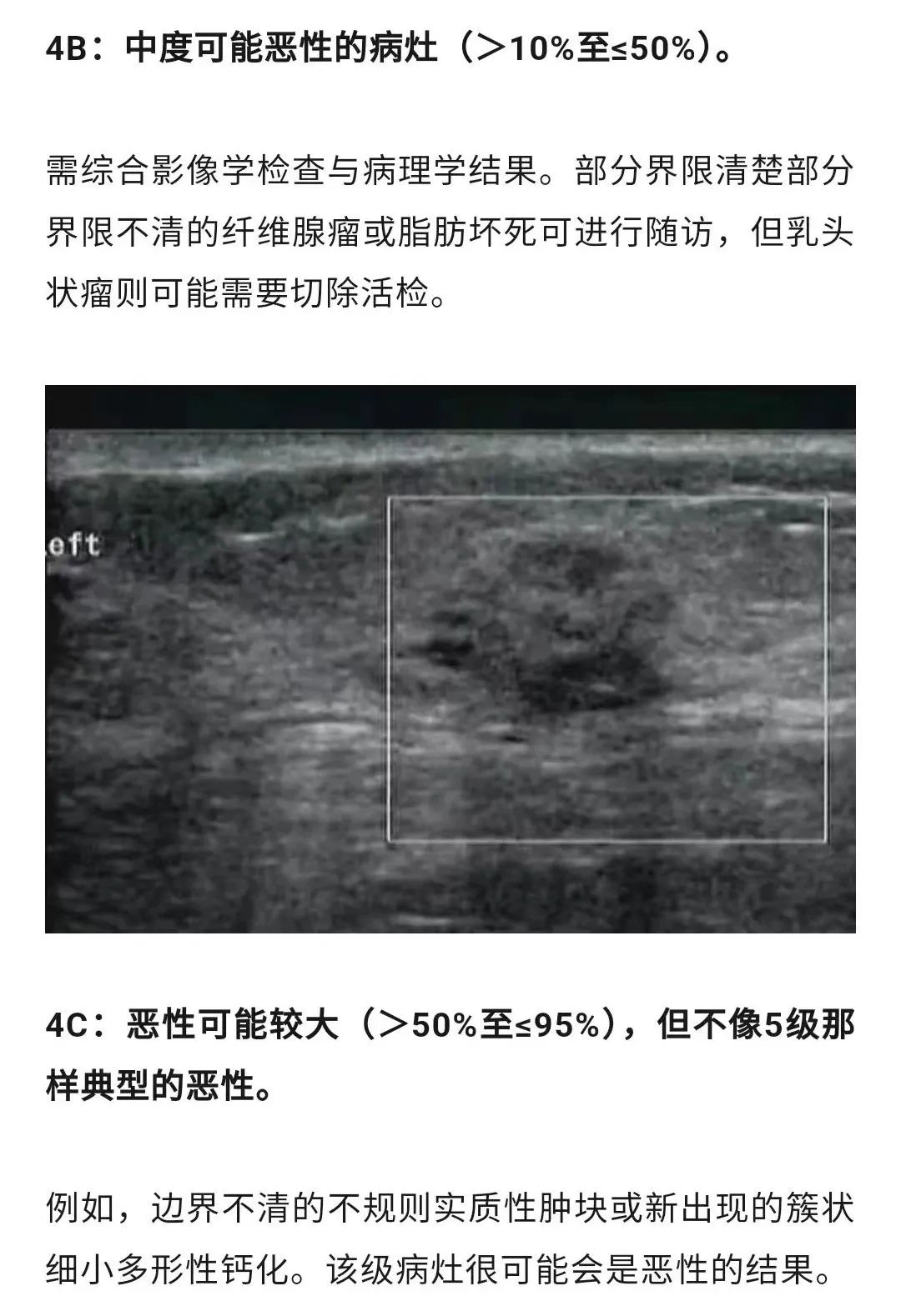 乳腺結(jié)節(jié)惡性的可能性有多大？一文讀懂乳腺結(jié)節(jié)BI-RADS分級標(biāo)準(zhǔn)！